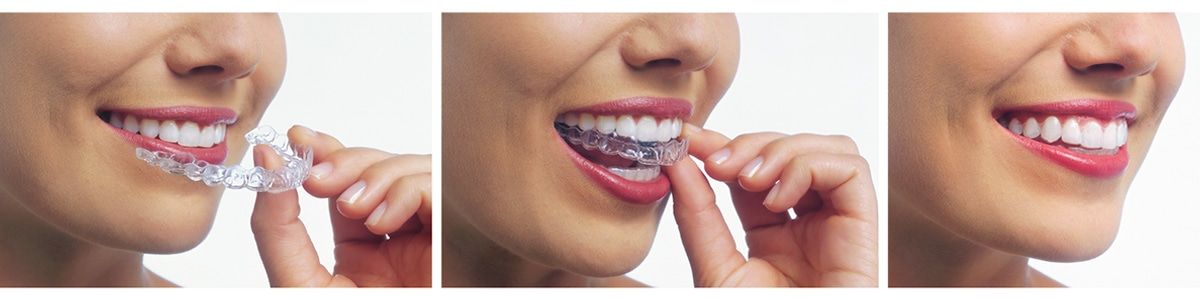 Invisalign Cost in Palos Verdes and South Bay, California