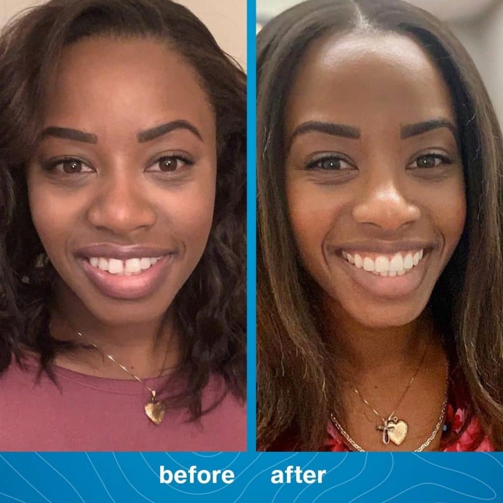 Invisalign in Palos Verdes and South Bay, California