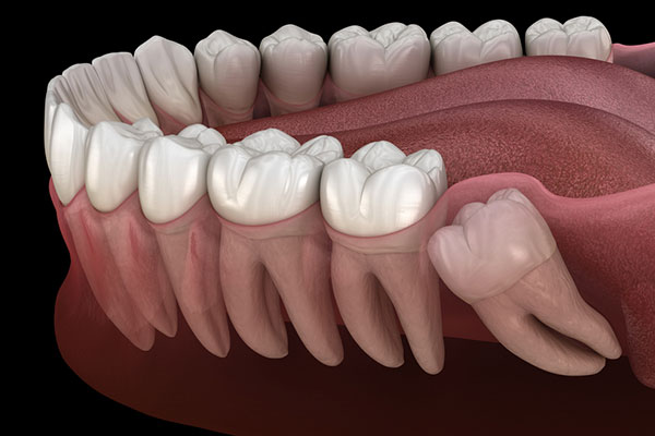 Wisdom Teeth Removal Cost In Palos Verdes And South Bay California